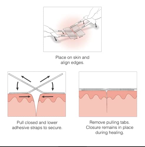 Clozex Emergency Laceration Closures